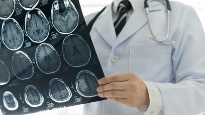 Banyak Anak Muda Kena Stroke, Kemenkes: Gaya Hidup Jadi Biang Kerok